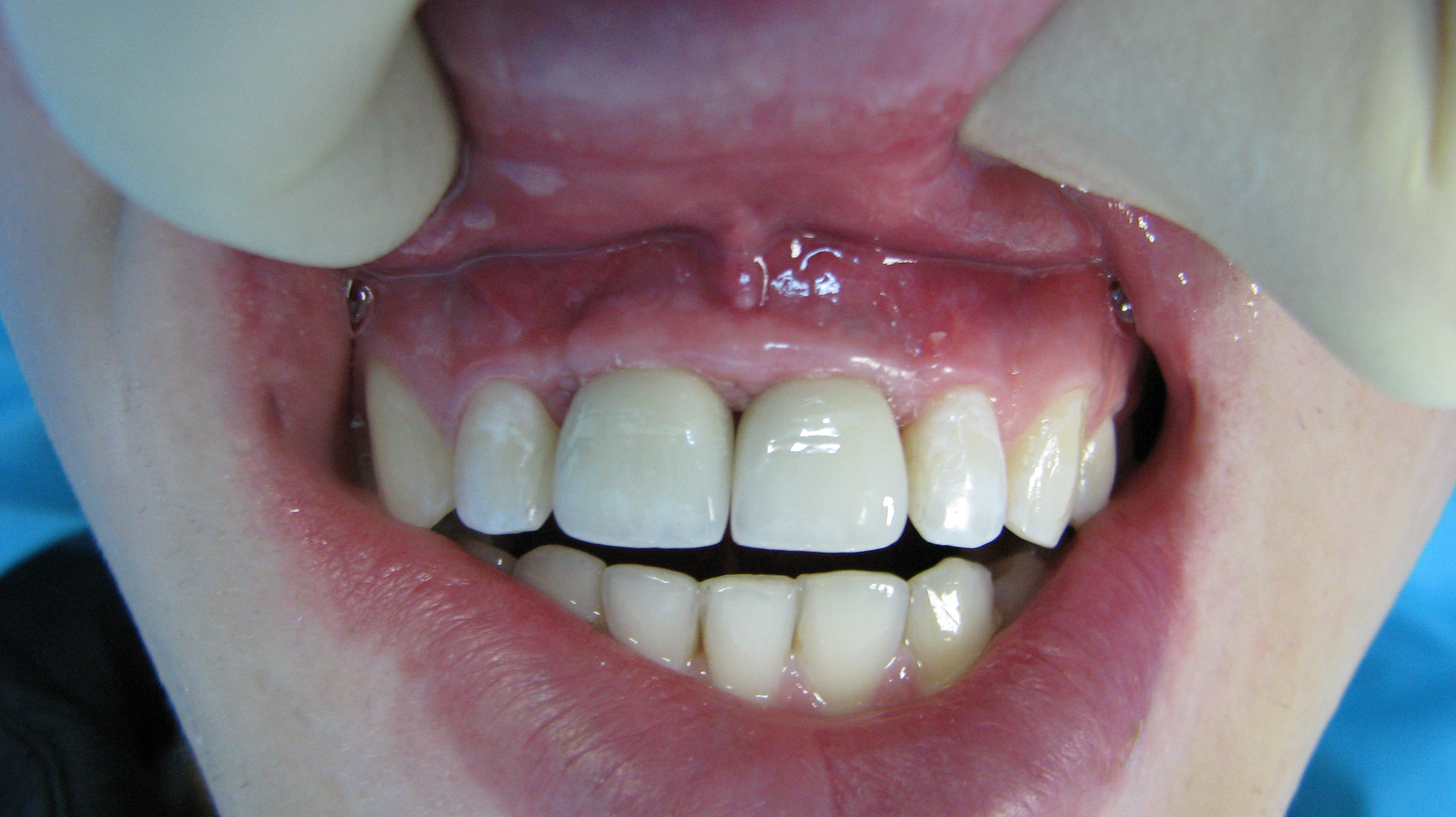 Kakoj-implant-luchshe-stavit'-na-perednie-zuby.JPG