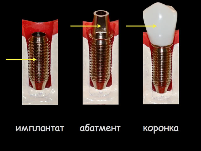 Ustanovka-koronki-pri-protezirovanii-na-implantah.jpg