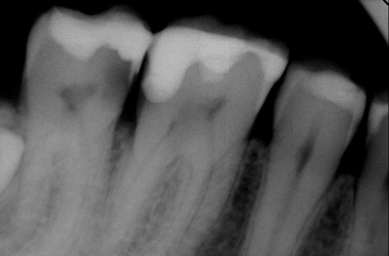 Болит зуб ночью-Как избавиться от зубной боли быстро