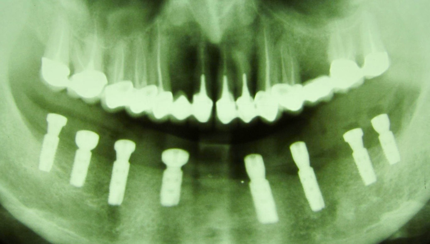 Skol'ko-stoit-implantacija-vseh-zubov.jpg