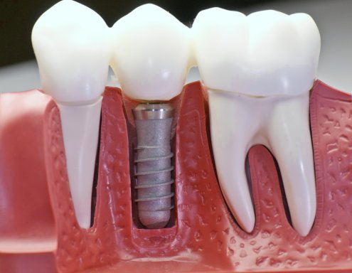 Skol'ko-stoit-zubnoj-implant.jpg