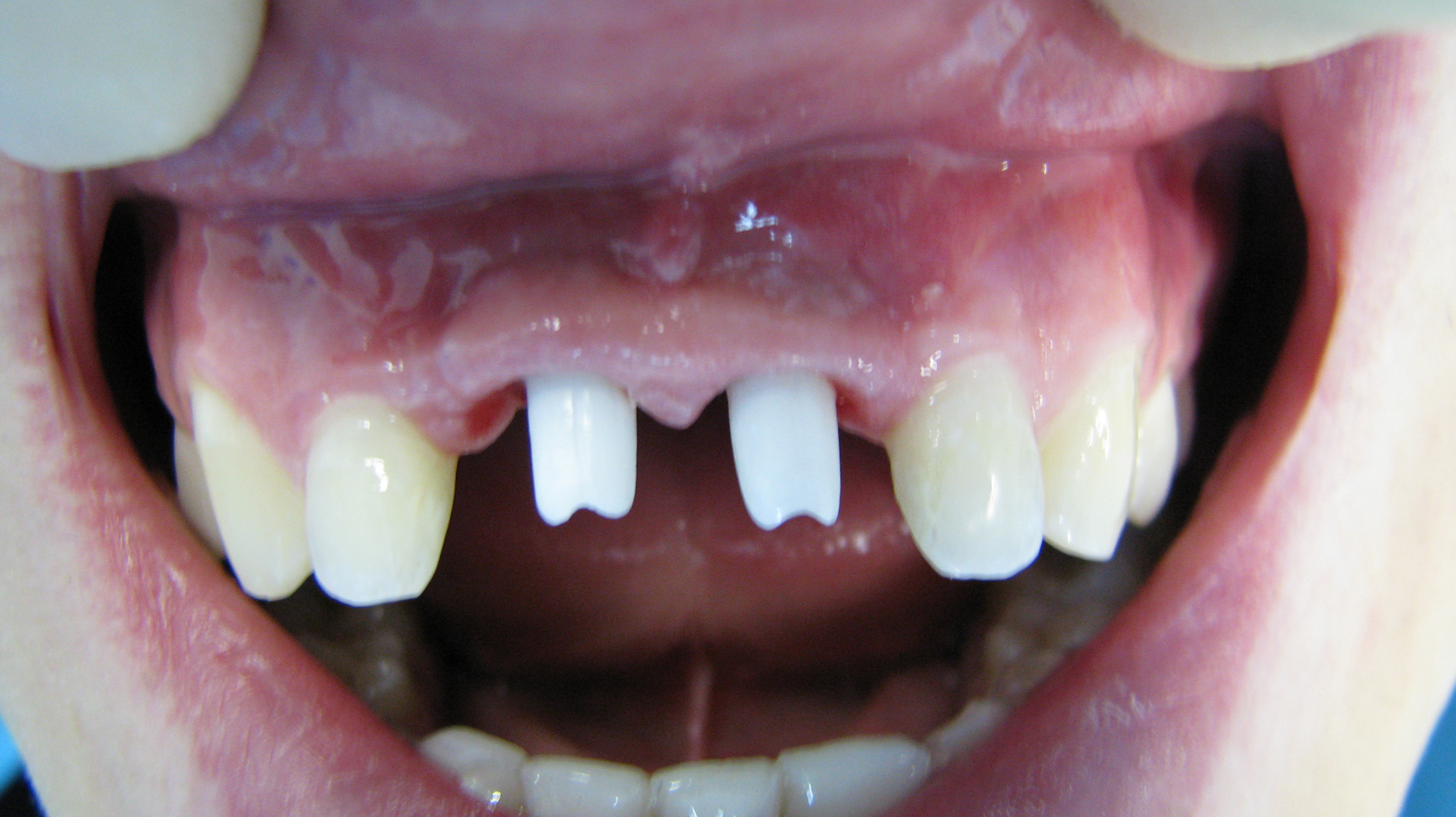 Kakoj-implant-luchshe-stavit'-na-perednie-zuby.JPG